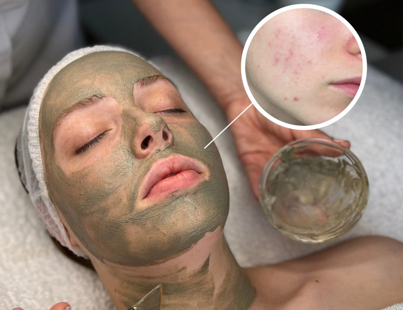 behandeling-biopeel5