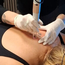 Tatoeage verwijderings behandeling